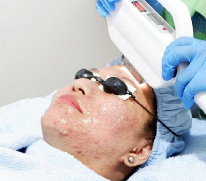 IPL Facial